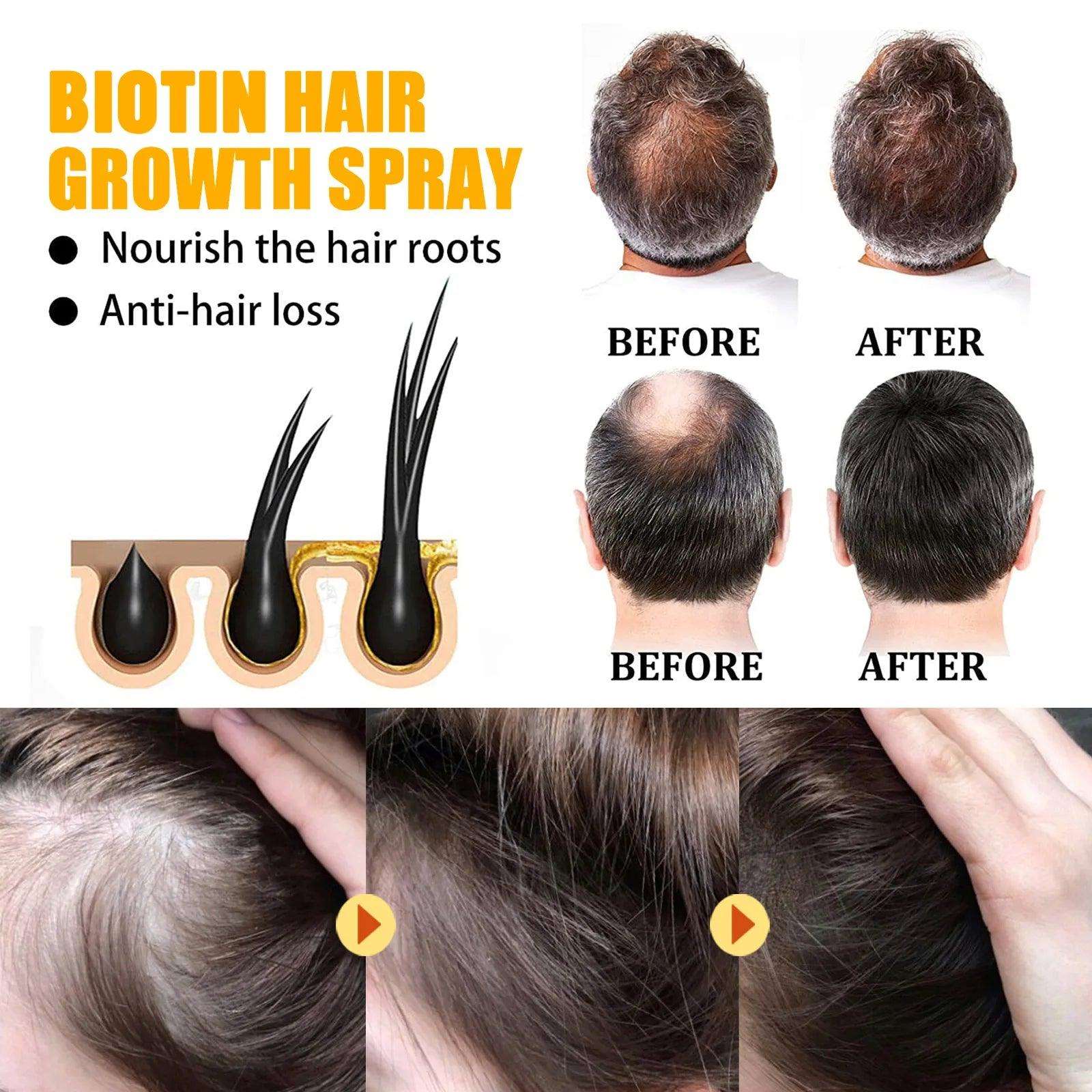 Biotin Hair Growth Spray Anti Dandruff Itching Treatment - hairandbeauty